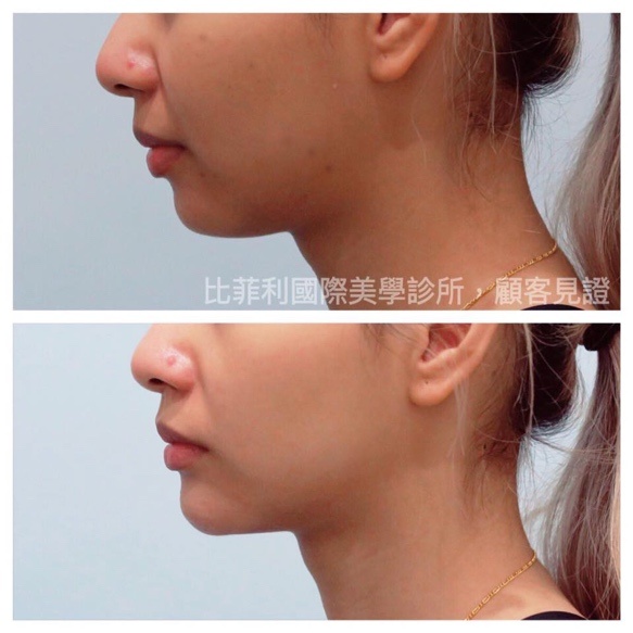 產後乳房下垂與妊娠紋肆虐怎麼辦？簡單幾招擺平產後困擾